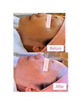 ミラー(MIRAOR)/顎ラインのもたつきもスッキリ☆