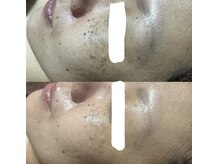 リスール(Re’seule)/SR光フォト