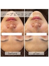 スタジオフラフィー(studio Fluffy)/施術画像｜ハーブピーリング