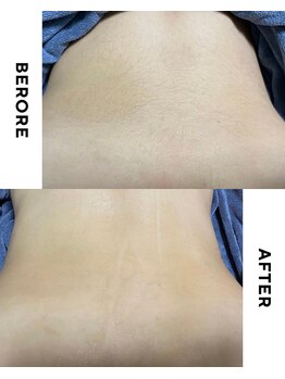 ゼロ(ZERO)/kids脱毛☆before&after