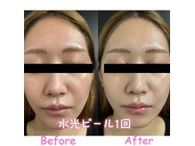 エーエスビューティーサロン(AS Beautysalon)の雰囲気（韓国定番【水光ピール】ムルトックス）