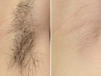 サロンドラッジ(Salon de Raggi)/【脱毛】脇