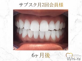 ホワイヤ セルフホワイトニング DBS神楽坂(Whi-Ya)/☆サブスク会員様☆納得の白さ☆