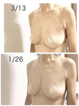 ベッピン(Beppin)/50代下垂/左右差/バストケア