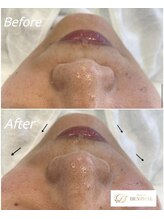 サロン ド デンファレ(salon de denphal)/ハイドラフェイシャル～小顔～