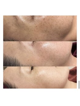 ルピナージュ(Lupinage)/【肌質改善】ハーブピーリング