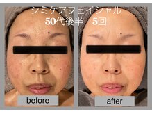 ブリノス(BLINOSS)/シミケアフェイシャル