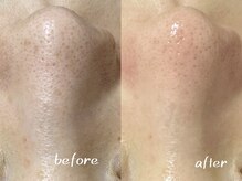 パールフェイスエステ ルペルル(PEARL FACE ESTHE la perle)/毛穴の黒ずみ改善