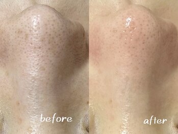 パールフェイスエステ ルペルル(PEARL FACE ESTHE la perle)/毛穴の黒ずみ改善