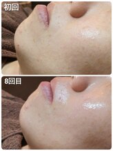 ウララ(ulala)/韓国ピーリングビフォアフ