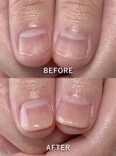 ポメロ(POMELO)/深爪をカバーする見た目改善