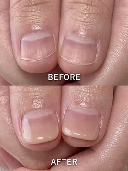 ポメロ(POMELO)/深爪をカバーする見た目改善