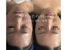 オーシャンブルーム 目黒(OceanBloom)/アンストレス／乳酸菌ピーリング