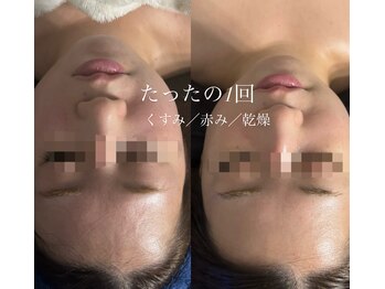 オーシャンブルーム 目黒(OceanBloom)/アンストレス／乳酸菌ピーリング