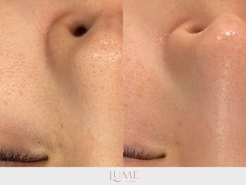 ルーミー 南青山(LUME)/ヒト幹細胞導入／鼻／黒ずみ