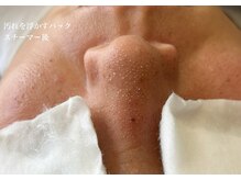 毛穴洗浄前のパック後