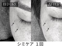 スキンジム(SKIN GYM)/見た目年齢を左右する目元のシミ