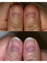 ティアラネイル 宇都宮/深爪矯正