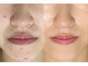 アンリミット 渋谷宮益坂店(Une limit)/【繰り返す顎のトラブル】