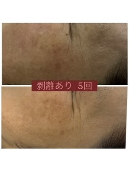 リリーグレース(Lily Grace)/ハーブピーリングハード)