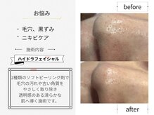 シロ(CHILO)/ハイドラbefore・after