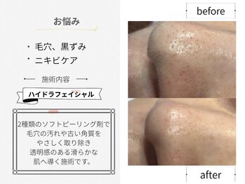 シロ(CHILO)/ハイドラbefore・after