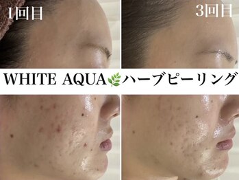 ホワイトアクア 錦糸町店(WHITE AQUA)/ハーブピーリング/毛穴/錦糸町