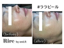リル バイ アンドアール(Rire by and.R)/ララピール（施術1回）