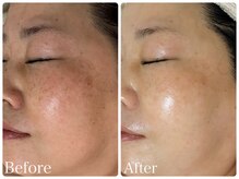 ロイヤル(ROYAL)/シミ/くすみ改善症例