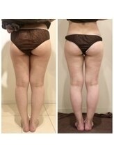 美人バスト つくば店/【ヒップアップ　症例】