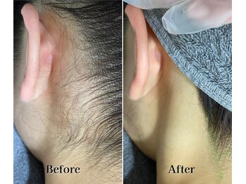 ライズ 札幌店(RISE)/うなじ・襟足の光脱毛