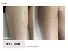 プリズム/女性膝下のビフォーアフター