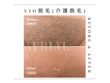 エアリアル 大川店の雰囲気（将来に向けての介護脱毛！40代～70代まで幅広く大人気♪）