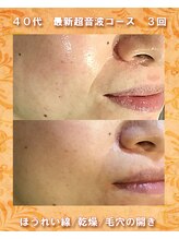 ナイア(naia)/最新型超音波コース