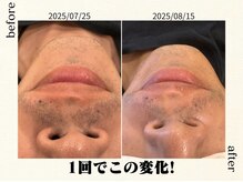 フォーマレイズ(Formalways)/ご自宅での保湿・剃毛で高効果◎