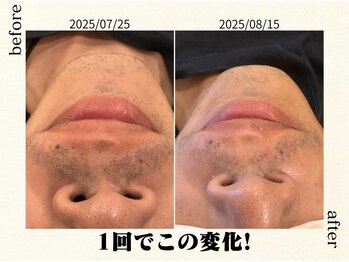 フォーマレイズ(Formalways)/ご自宅での保湿・剃毛で高効果◎