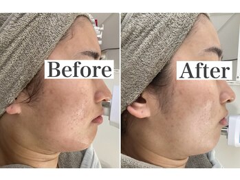 ホリシア 博多(HORISHIA)/ララピール/毛穴/ニキビケア