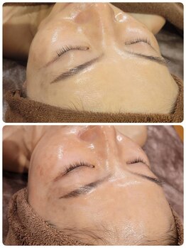 サロン ポム(salon pom)/◇かんぱんお悩みBeforeAfter◇