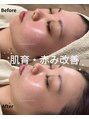 ユンプラス(yun+) 《本郷/春日/艶肌/フェイスワックス/ピーリング/毛穴洗浄/小顔》