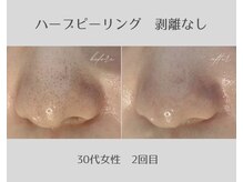 アールエスト(R EST.)/ハーブピーリング黒ずみ毛穴改善