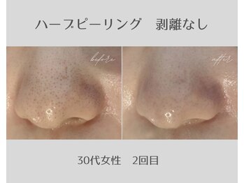 アールエスト(R EST.)/ハーブピーリング黒ずみ毛穴改善