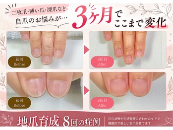 ナユネイル(na_yu.nail)の写真/二枚爪・薄い爪・深爪…「私の爪も変われる?」そんな方へ
