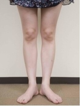 船橋カイロプラクティック/美脚矯正でO脚改善!!