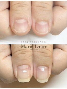 マリーロール 天王寺店(Marie Laure)/自爪育成/深爪矯正/ネイルケア
