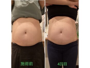 柏の葉オレンジ整体院/スマートスカルプト途中経過！