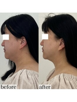 ヴェルシック(Belchic)/自信を持てる理想の輪郭へ