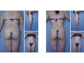 Nビューティー/最新エンダモロジーBODY