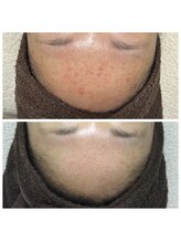 リラーナ(Re rana)/赤み・敏感肌3回目♪