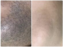 サロンドラッジ(Salon de Raggi)/【脱毛】顔・髭