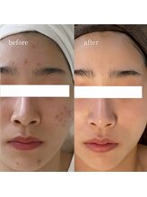 アーネスト 大阪心斎橋店(EARNEST)/本気の肌質改善【 PHA＋水光 】